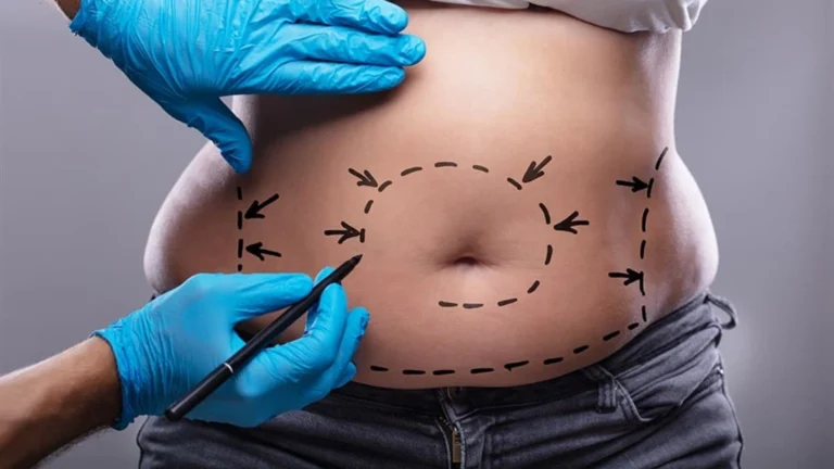 liposuction
