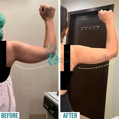 liposuction-aesthetic-enhancement