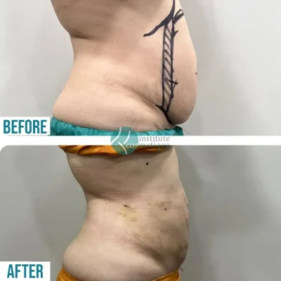 liposuction-slimming-results